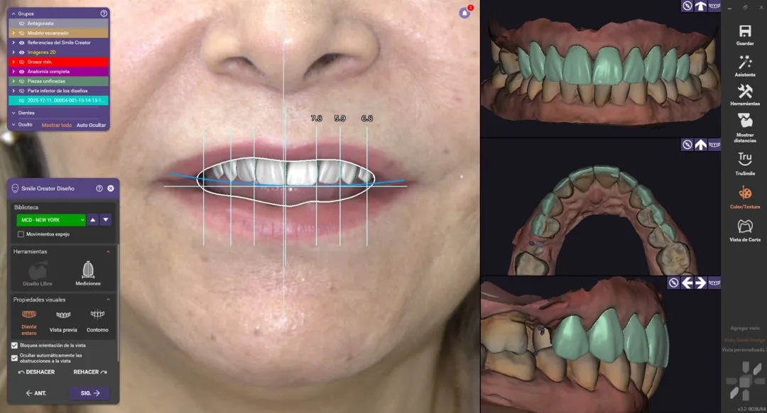 Diseño de sonrisa - caso 1