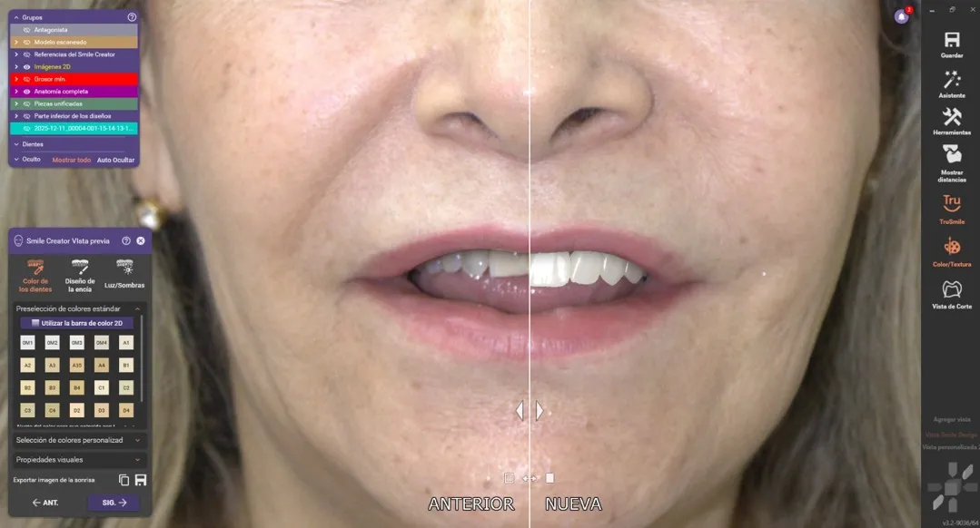 Diseño de sonrisa - caso 2