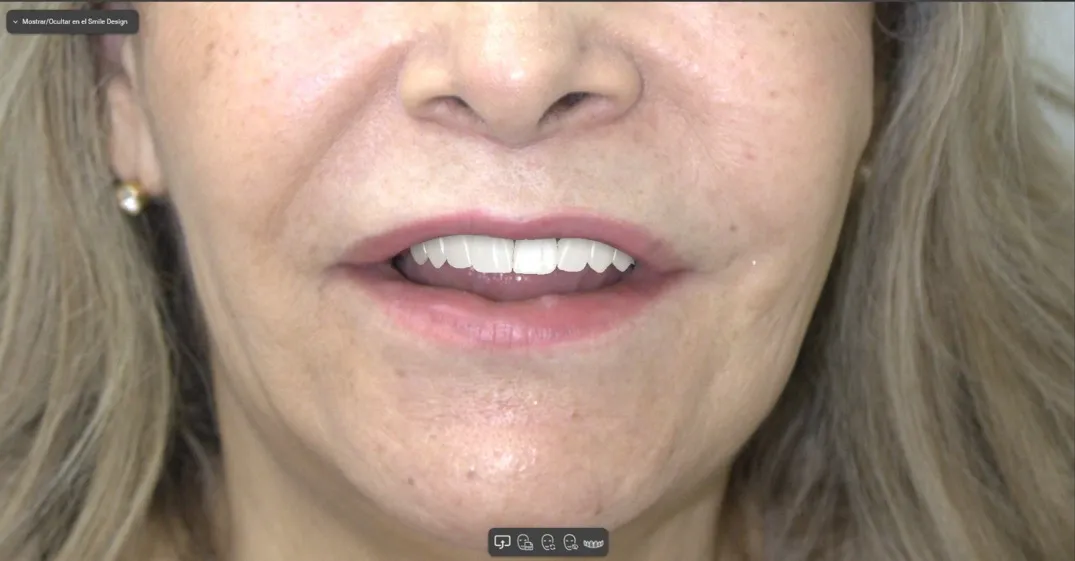 Diseño de sonrisa - caso 3