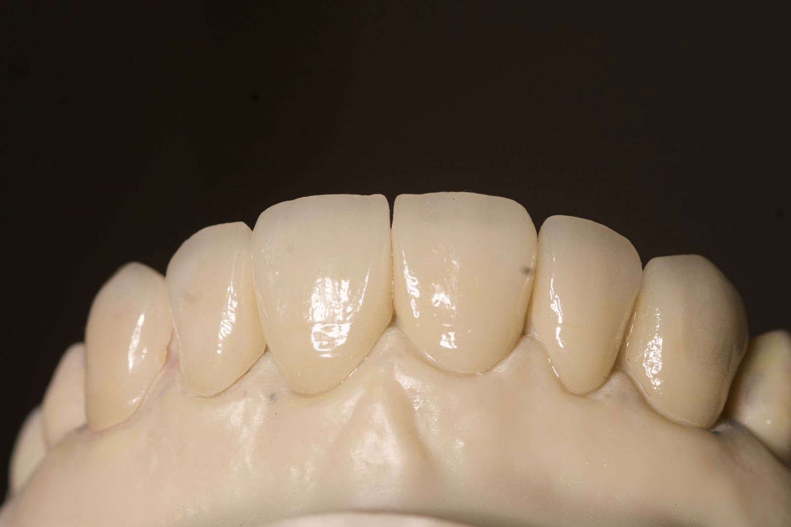 Diseño de sonrisa - caso 4