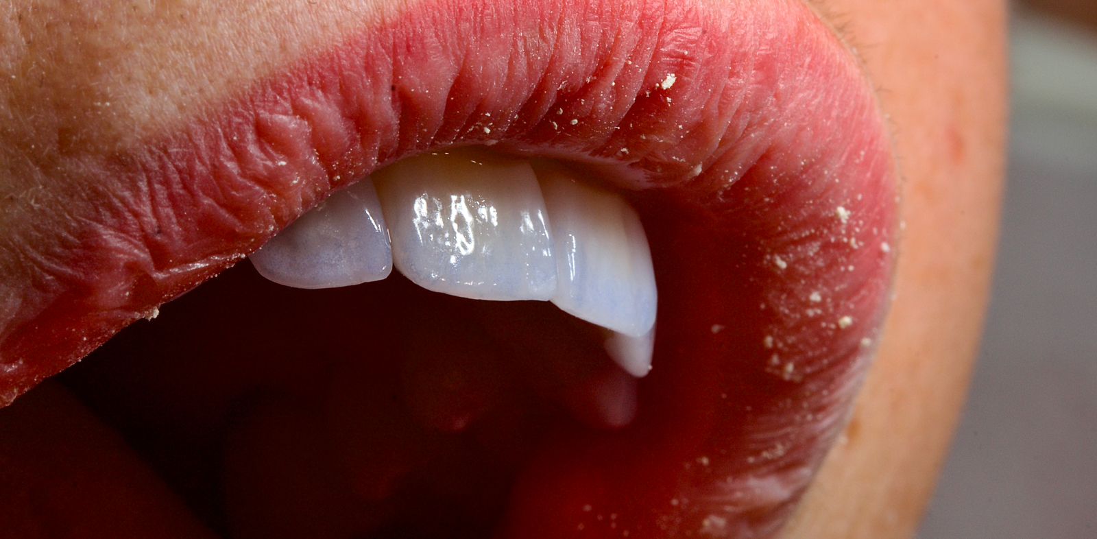 Diseño de sonrisa - caso 5