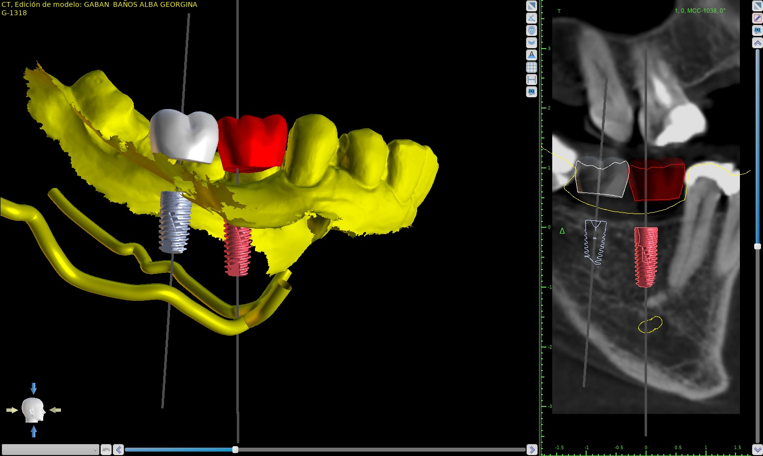implantes dentales