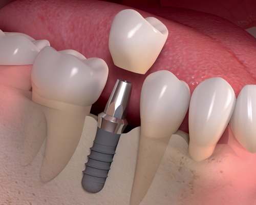 implantes dentales