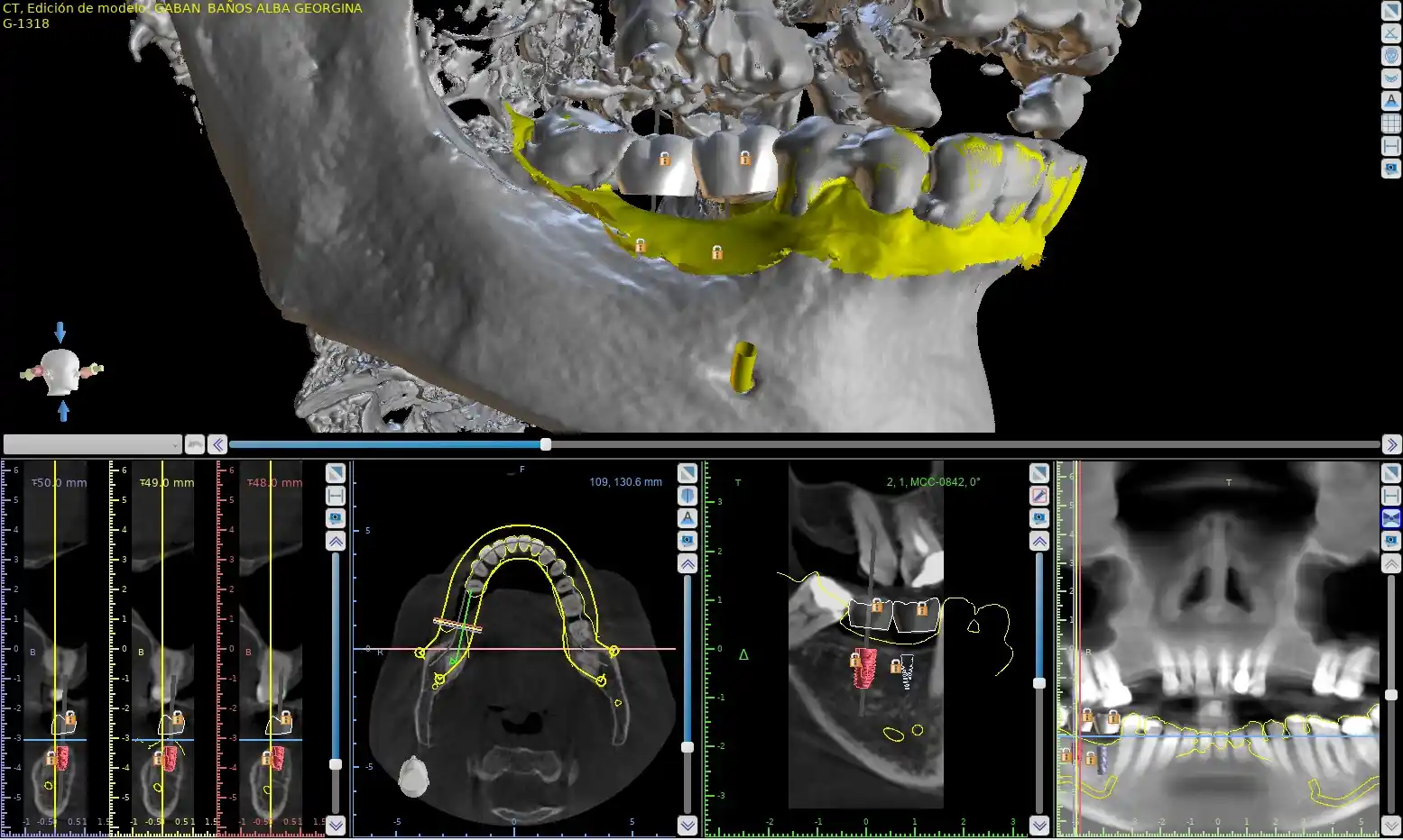implantes dentales