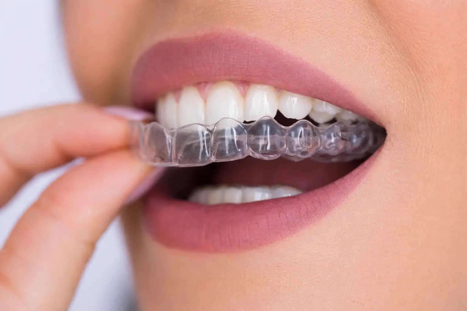 Ortodoncia invisible - caso 1